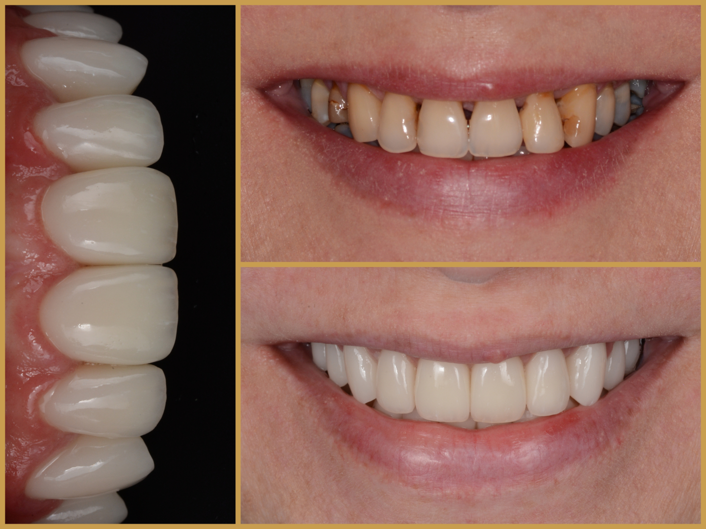 előtte-utána fogászati kezelés