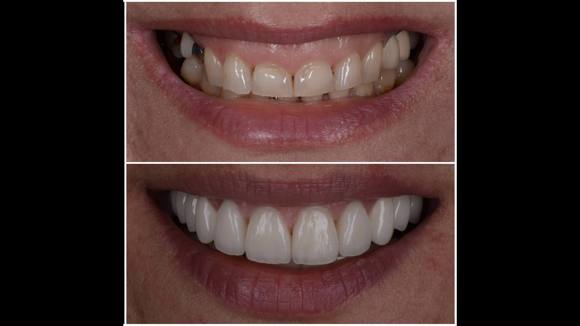 Előtte-utána fogpótlás