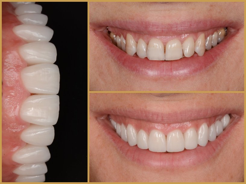 Esztétikai fogászat előtte utána