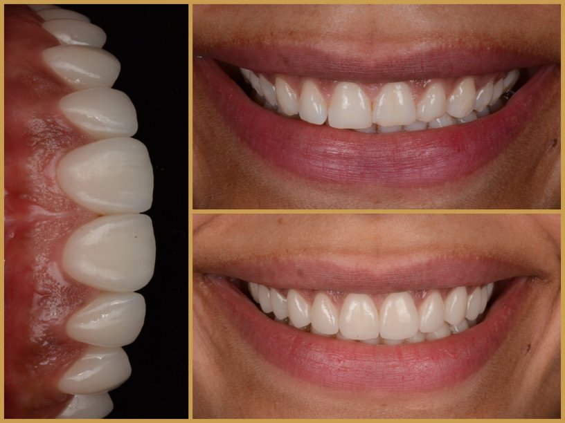 Esztétikai fogászat előtte utána