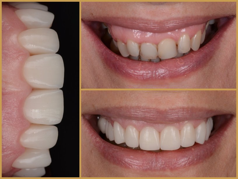 Esztétikai fogászat előtte utána