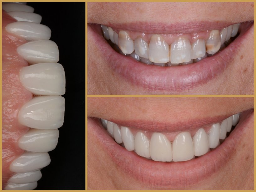 Esztétikai fogászat előtte utána