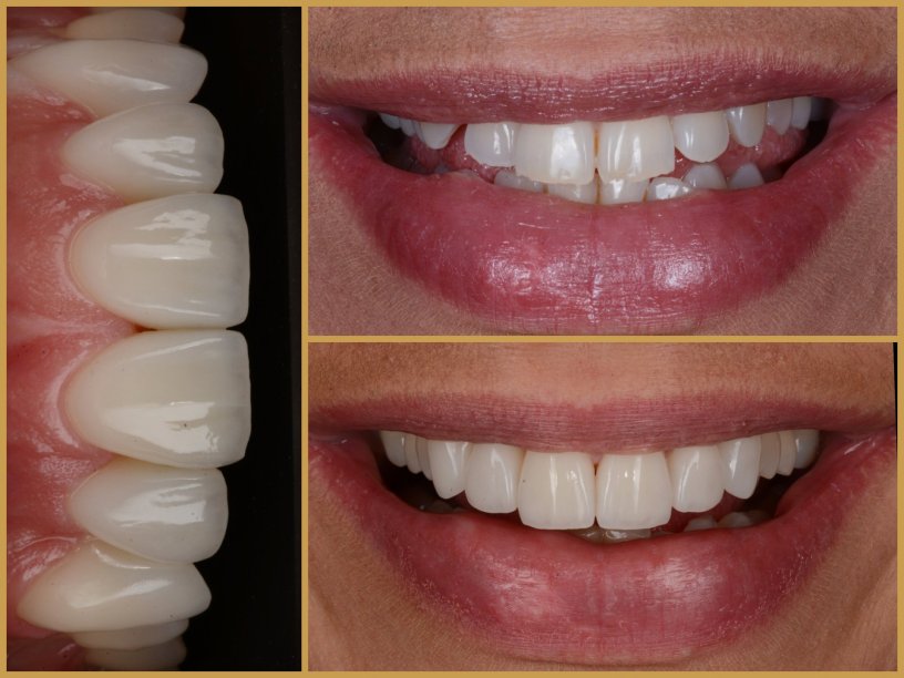 Esztétikai fogászat előtte utána
