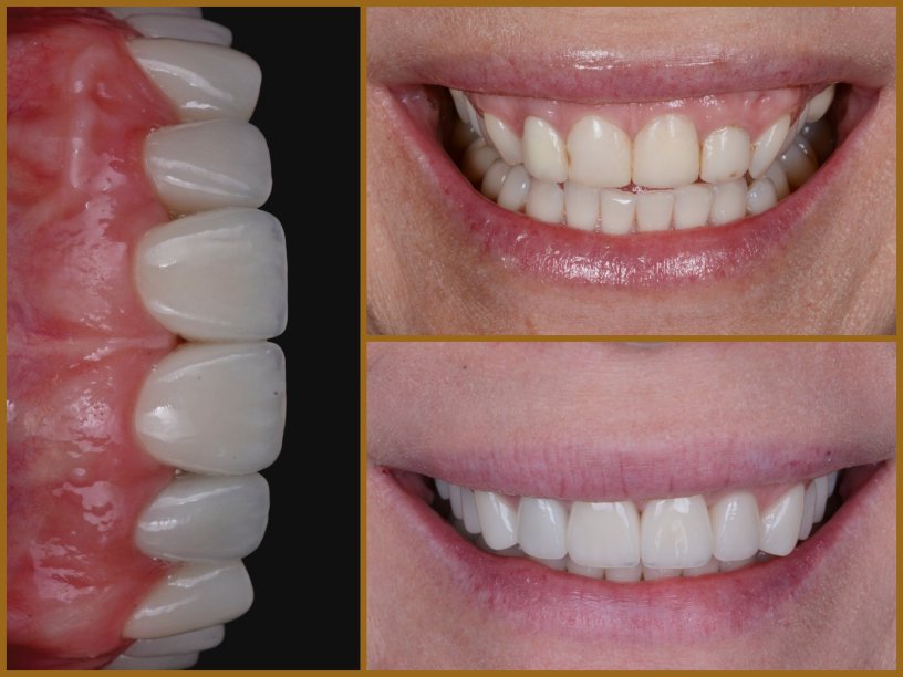 Esztétikai fogászat előtte utána