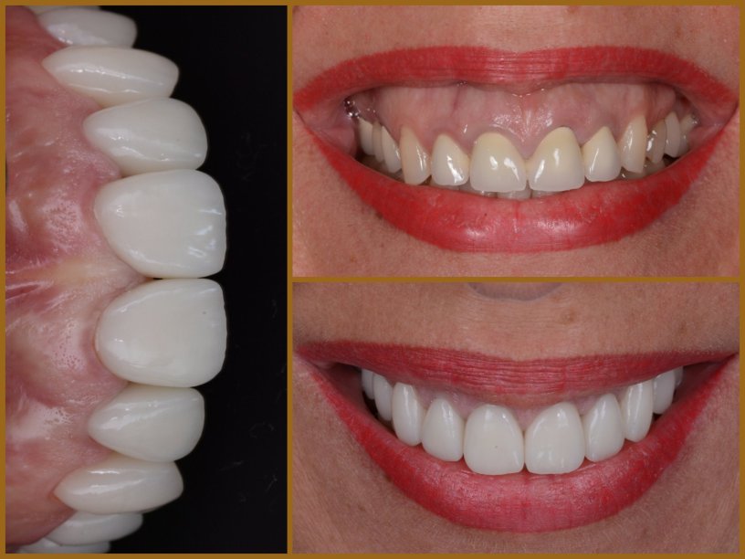 Esztétikai fogászat előtte utána