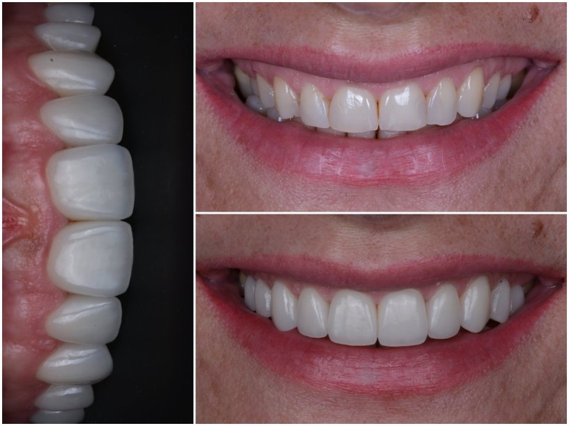 Esztétikai fogászat előtte utána