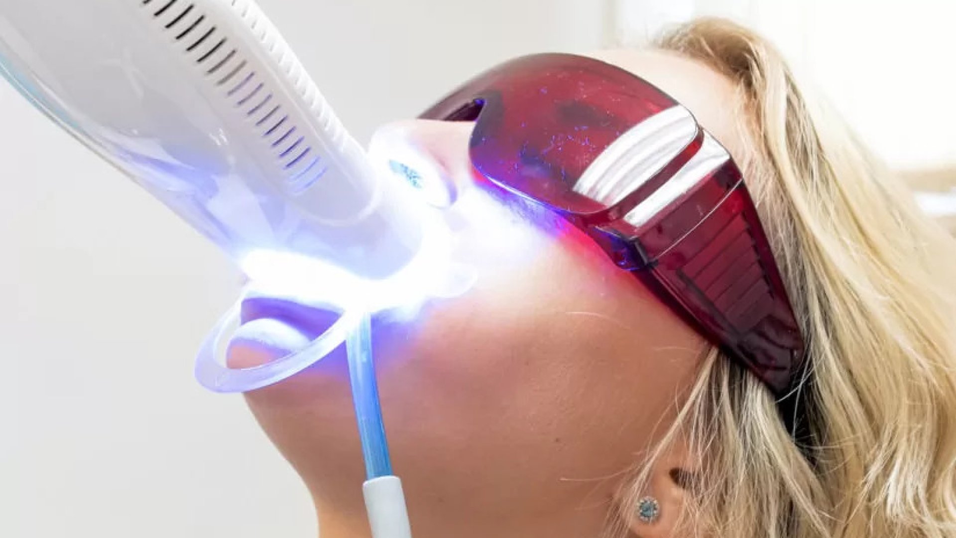 Ne dőljünk be az otthoni fogfehérítésnek! Miért érdemes a professzionális megoldásokat választani?