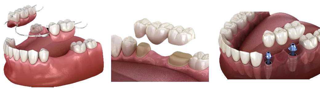 a-fogpotlasok-tipusai-01