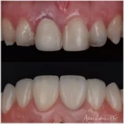 femmentes-fogpotlasok