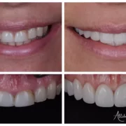 kozmetikai-fogaszat-03