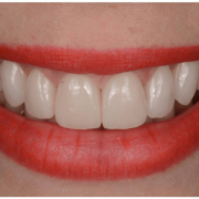 kozmetikai-fogaszat-04