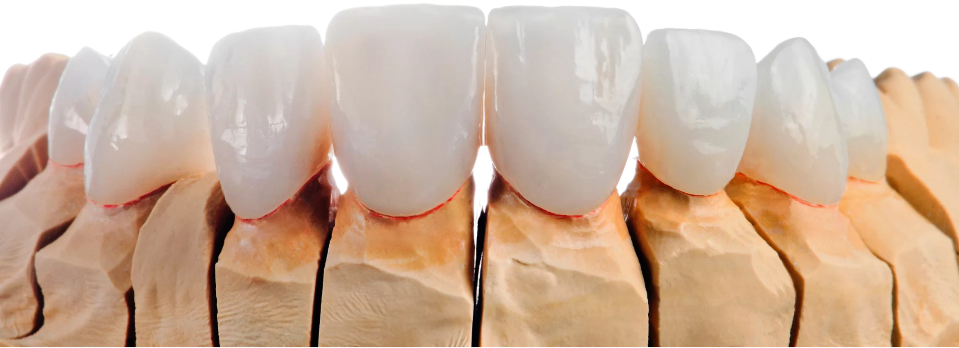 Minden amit a porcelán vagy kerámiahéjakról tudni szeretett volna!