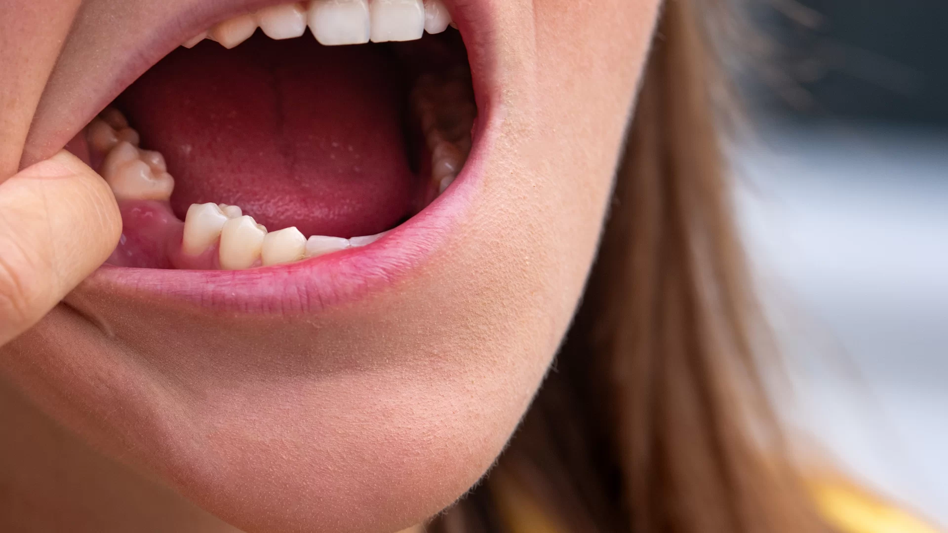 Miért probléma a foghiány?