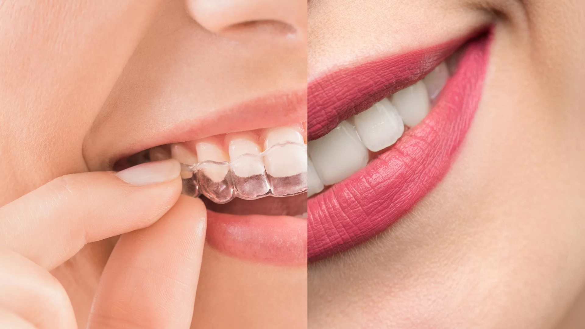 Porcelán héj vagy fogszabályozás?