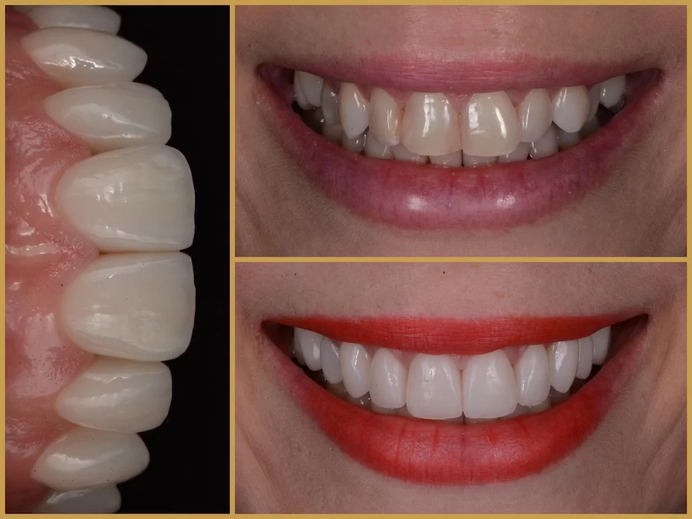 Kerámiahéj: Nem csak a hollywoodi sztárok kiváltsága