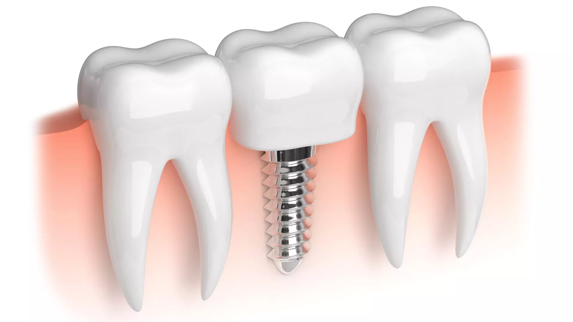 Mennyire tartósak a fogászati implantátumok?