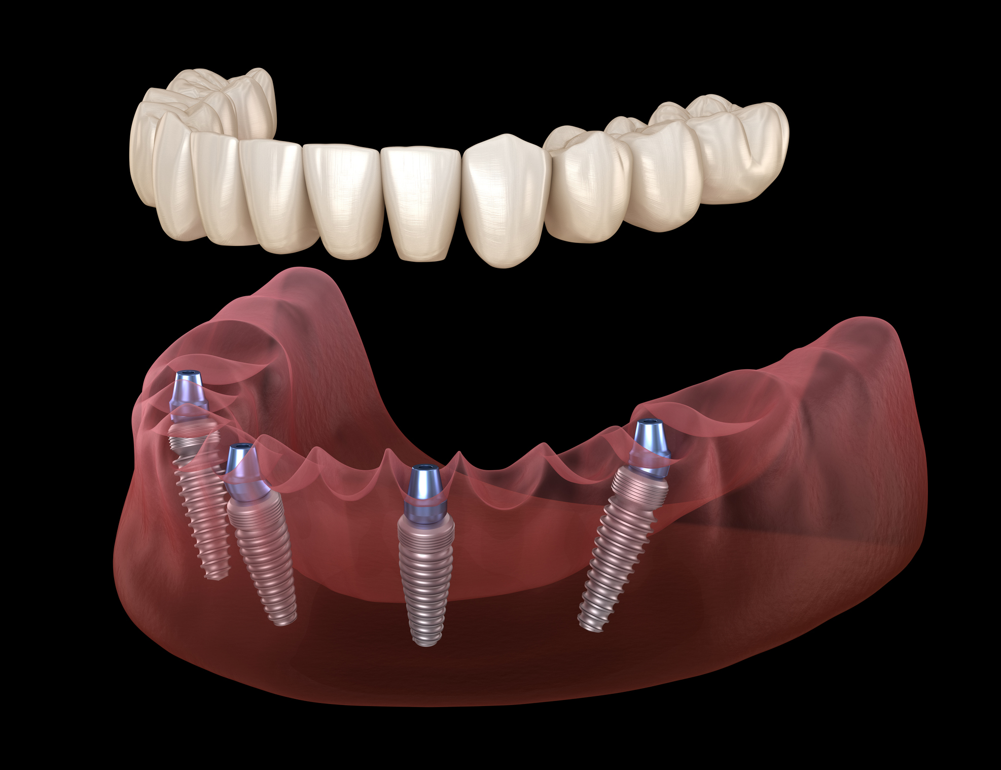 All-on-4 implantátum Budapest – teljes fogsor modern technológiával