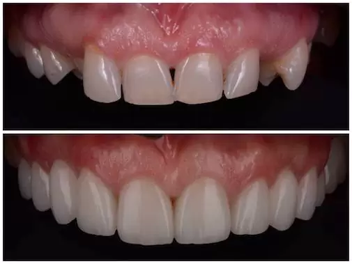 ALL-ON-6 IMPLANTÁTUM