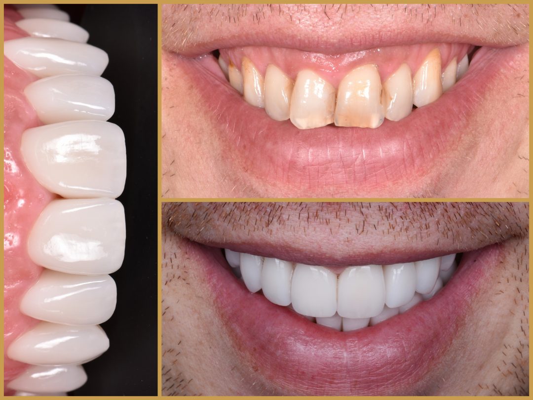 Esztétikai fogászati eredmény