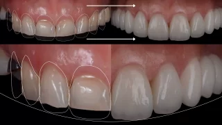 eksüvői mosolyátalakítás