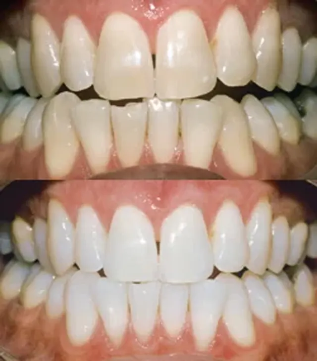 Fogfehérítés professzionálisan