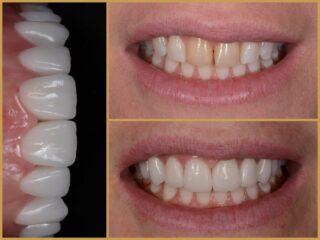 professzionális fogfehérítés