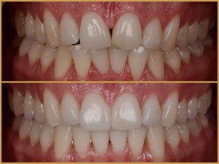 Láthatatlan fogszabályozás eredmények