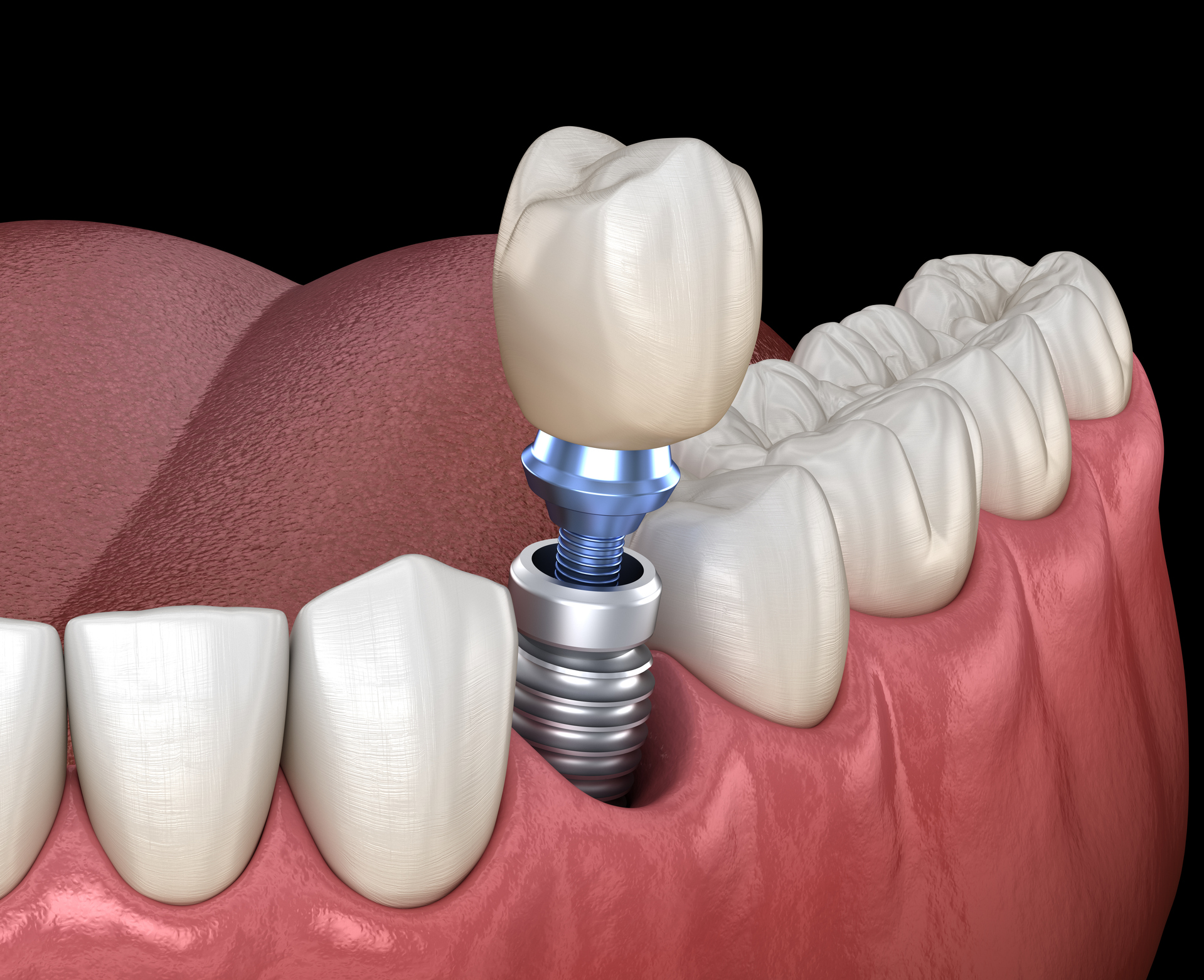 Fogimplantáció lépésről lépésre – ismerje meg, hogyan zajlik a modern implantátumbeültetés