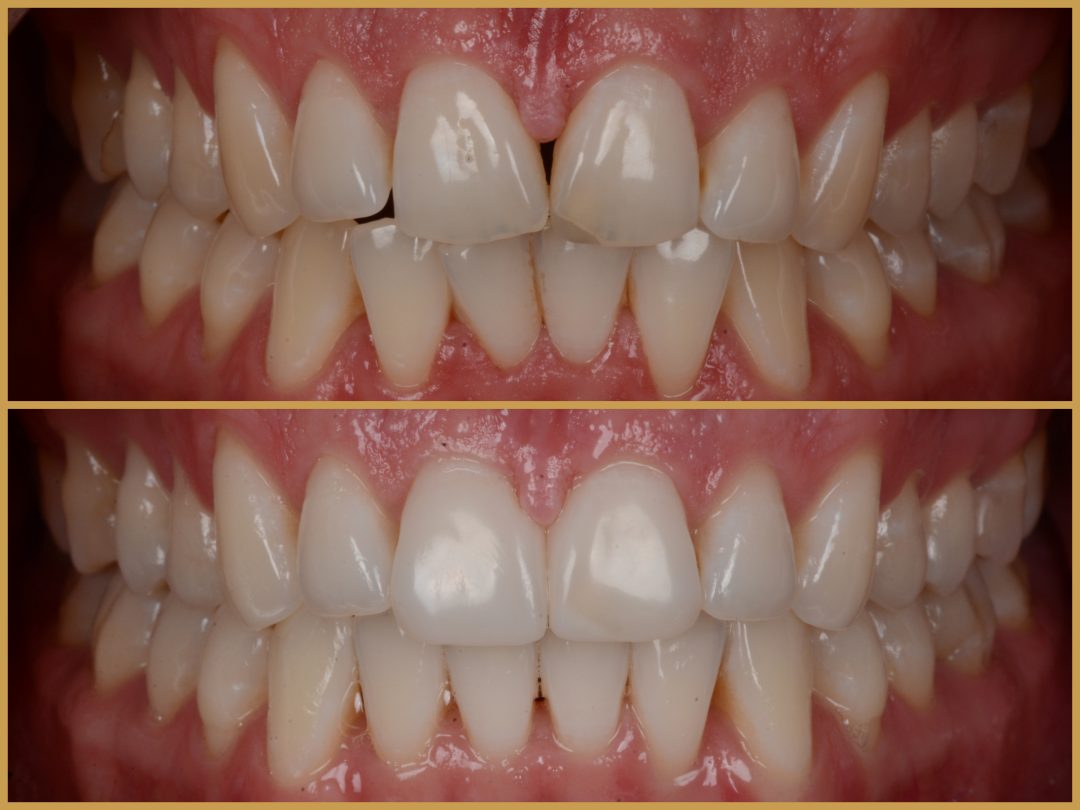 Invisalign fogszabályozás