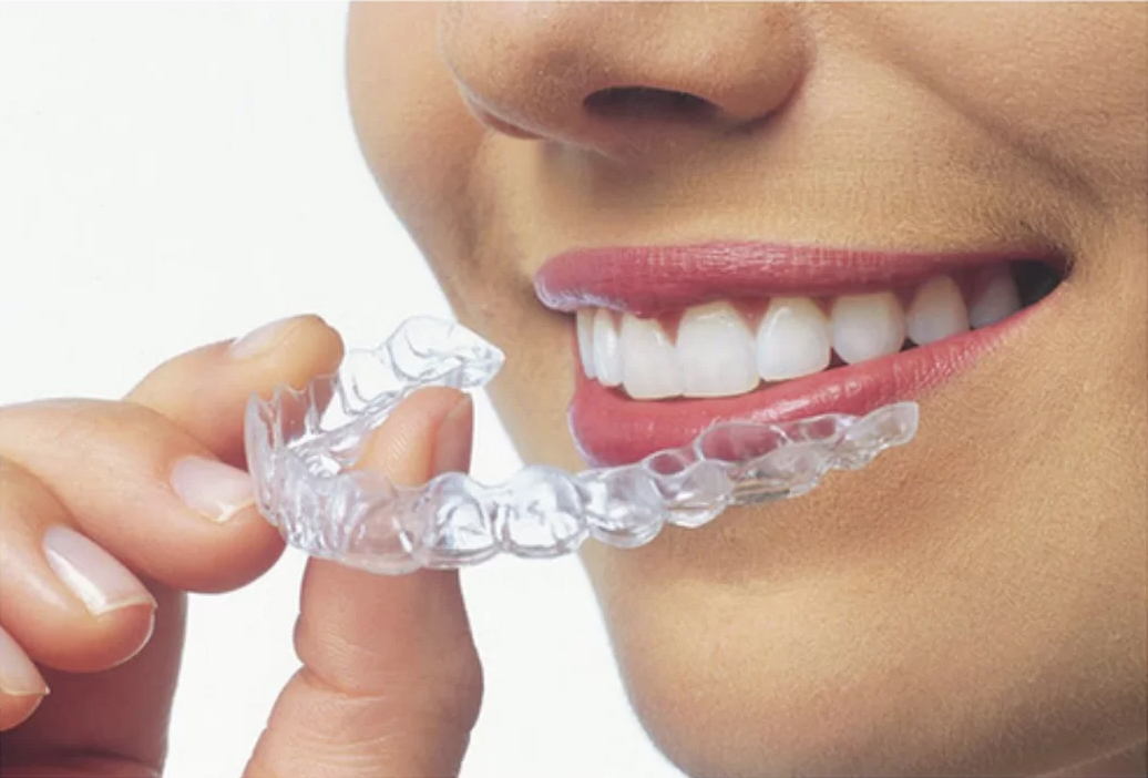 Felnőtt fogszabályozás Budapesten – kizárólag Invisalign megoldással a SmileCenterben