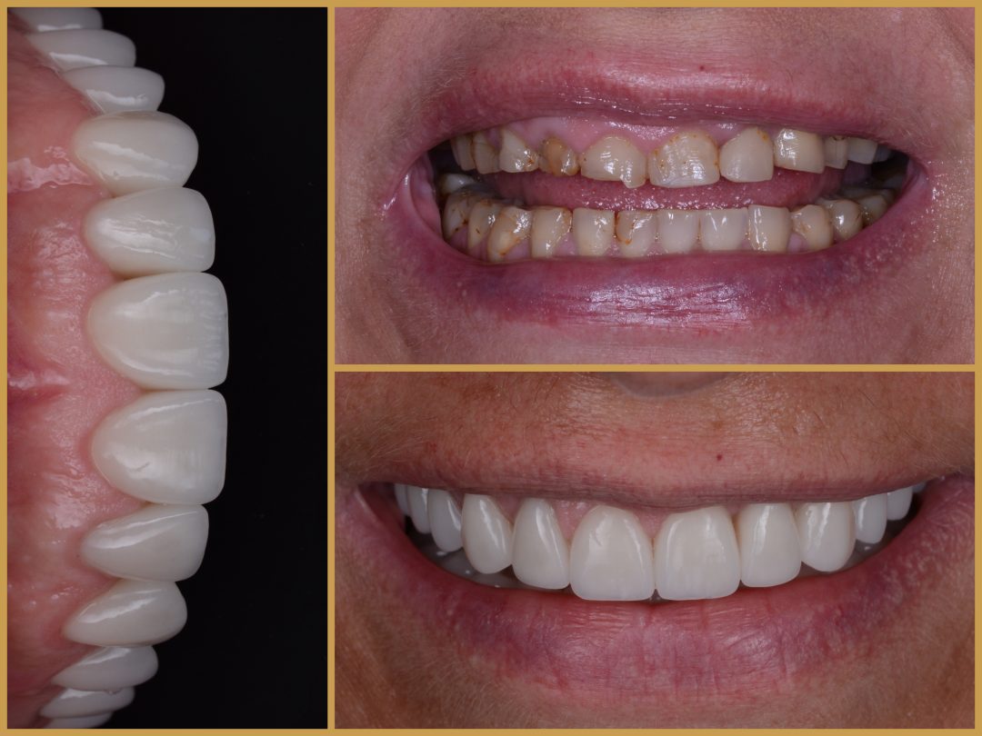 Teljes fogpótlás eredmény