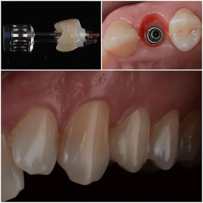 Implantacio_smilecenter-3