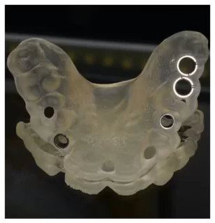 dig-fogimplant-4-2-3