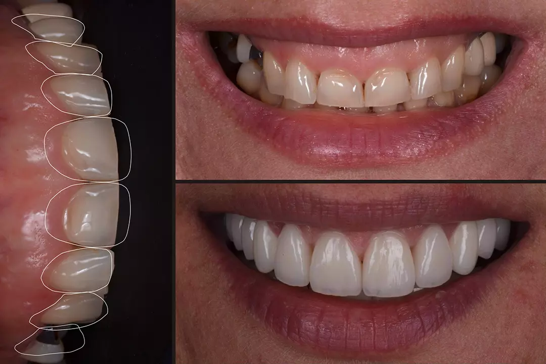 professzionális fogpótlás Budapesten