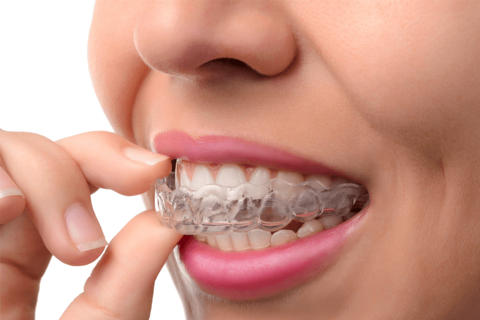 step 4 / invisalign