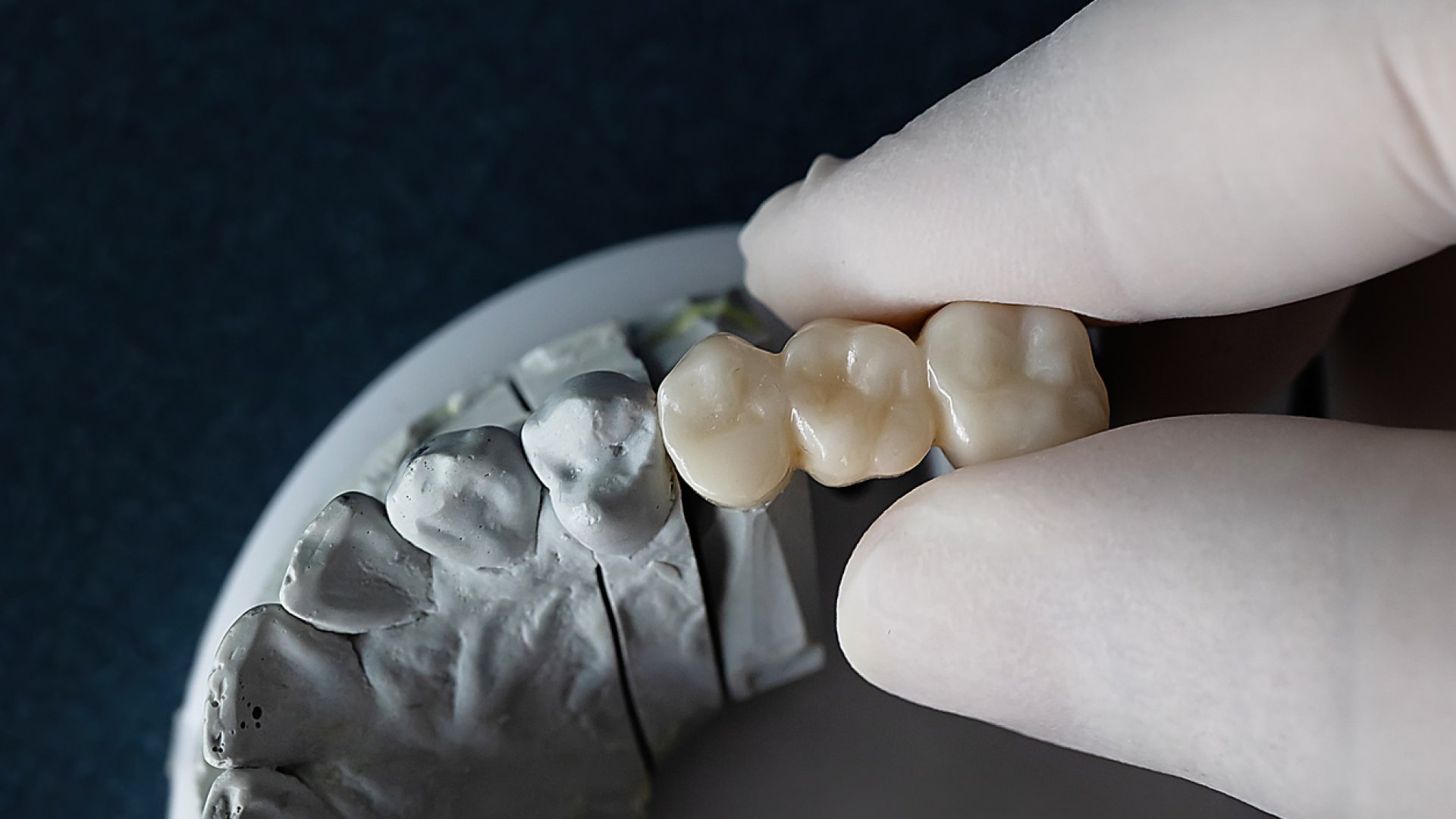 Milyen fogkorona típusok vannak? – Útmutató | SmileCenter