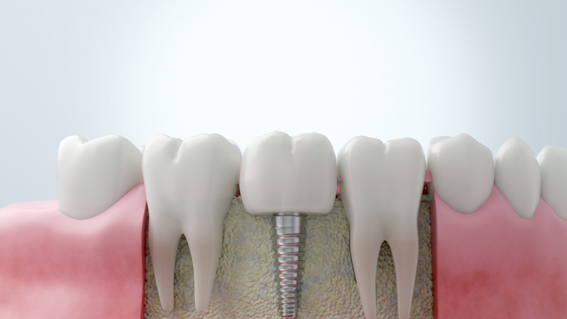 Mikor van szükség csontpótlásra fogbeültetés előtt? | SmileCenter