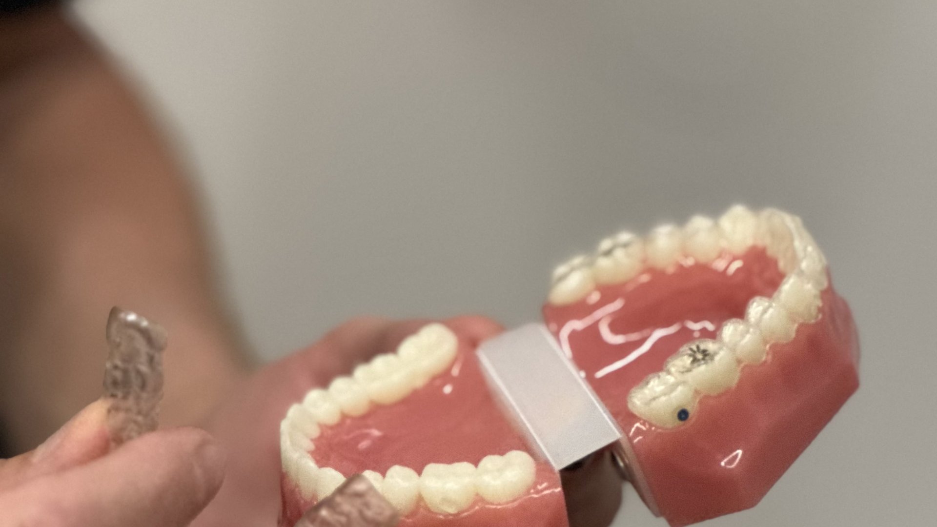 Fogszabályozás árak Budapesten a SmileCenterben