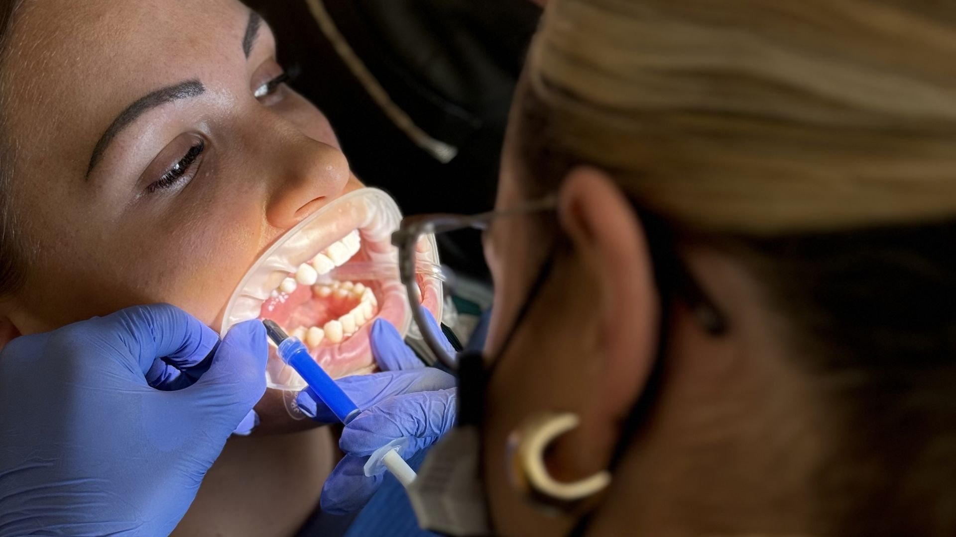 Invisalign a mindennapokban