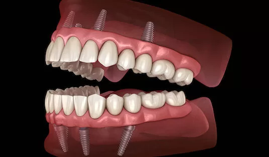 all-on-4-dental-implants-houston-1170x684-2