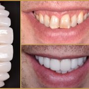 Esztétikai fogászati eredmény